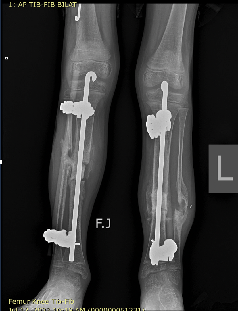 xray image with rods placed to keep the legs straight