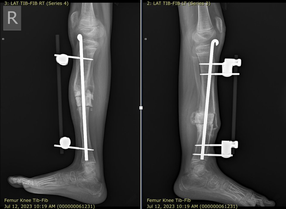 x-ray images of legs with rods inside